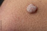 HPV : peut-on être porteur du virus sans le savoir ? Oui, c’est possible !