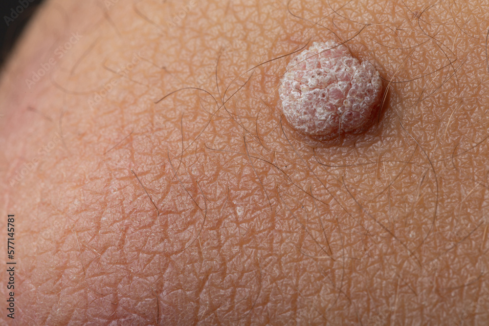 HPV : peut-on être porteur du virus sans le savoir ? Oui, c’est possible !